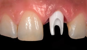 Corona in zirconia-ceramica su impianto