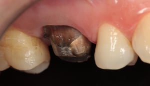 CC_Zirconia-Post_03-1