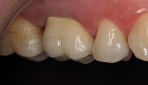 CC_Zirconia-Post_09-1