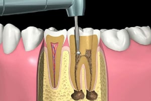 Devitalizzazione – applicazione materiale: strumento odontoiatrico che posiziona il materiale di riempimento nel dente trattato.