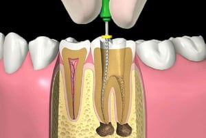 Devitalizzazione – completamento riempimento: sezione del dente con canali radicolari riempiti e sigillati.