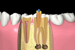 Devitalizzazione – svuotamento canali: rimozione della polpa dentale con strumento endodontico.