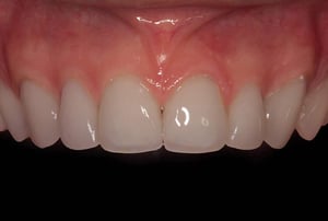 Digital Smile Design dopo