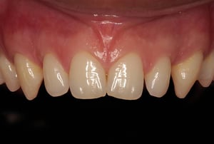 Digital Smile Design prima