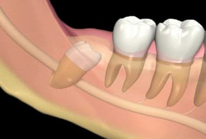 Illustrazione 3D che mostra un dente del giudizio inferiore incluso e inclinato, vicino al nervo mandibolare, all’interno della mandibola.