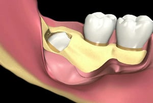Illustrazione 3D che mostra il dente del giudizio sezionato e pronto per l’estrazione chirurgica, con esposizione dell’osso mandibolare