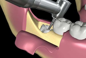 Illustrazione 3D dell’estrazione di una radice del dente del giudizio dopo la separazione della corona