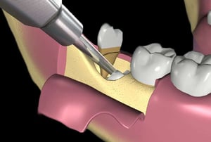 Illustrazione 3D dell’utilizzo di una fresa chirurgica per rimuovere parte dell’osso attorno al dente del giudizio incluso