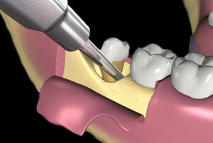 Illustrazione 3D della cavità ossea mandibolare dopo la rimozione del dente del giudizio, con i denti adiacenti visibili