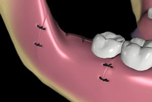 Illustrazione 3D della gengiva suturata dopo l’estrazione del dente del giudizio, con punti di sutura neri visibili