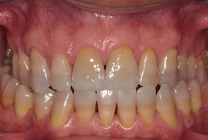 Faccette dentali incisivi - dopo