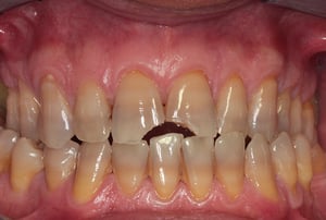 Faccette dentali incisivi - prima