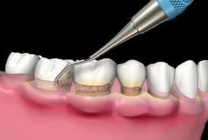 Pulizia professionale dei denti con strumento rotante per rimuovere macchie e tartaro