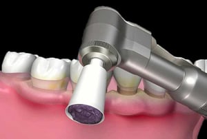 Levigatura radicolare con curette per eliminare placca e tartaro sotto gengiva