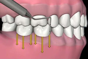 Sondaggio gengivale con sonda parodontale che mostra la profondità delle tasche.