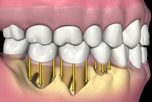 Illustrazione della perdita di osso alveolare dovuta a parodontite.