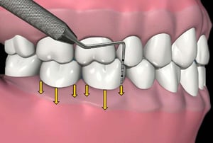 Esempio di sondaggio parodontale multiplo per la diagnosi di malattia parodontale.