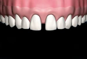 Preparazione del dente per faccette dentali – limatura minima dello smalto per creare lo spazio necessario all’applicazione della faccetta.