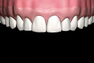 Microfaccette additive8