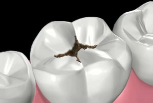 Otturazioni in composito – dente sano: vista del molare integro prima del trattamento.