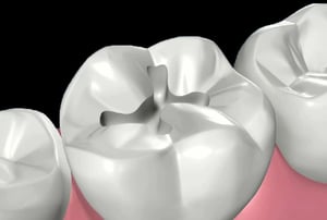 Otturazioni in composito – applicazione iniziale: inserimento del materiale composito nella cavità dentale.