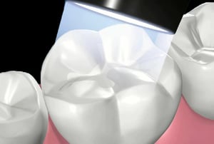 Otturazioni in composito – rimozione carie: utilizzo del trapano odontoiatrico per eliminare la parte cariata.