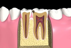 polpa necrotica: sezione del dente con carie superficiale