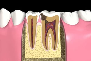 polpa necrotica: sezione del dente con carie profonda e polpa completamente necrotica.
