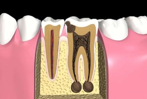 Sezione di due denti che mostra carie avanzata con necrosi pulpare e lesioni periapicali