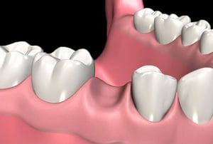 Protesi fissa – denti naturali: vista dell’arcata dentale con elementi sani prima del trattamento.