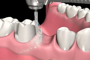 Protesi fissa – ponte dentale: protesi fissa a tre elementi pronta per essere posizionata sui monconi.