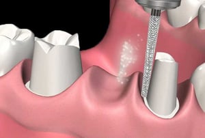 Protesi fissa – preparazione moncone: rifinitura di un dente pilastro con fresa odontoiatrica.
