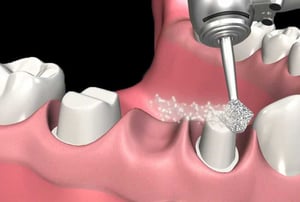 Protesi fissa – sagomatura moncone: utilizzo di fresa cilindrica per modellare il moncone.