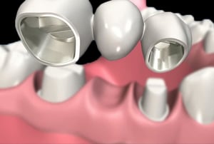 Protesi fissa – preparazione pilastro posteriore: rifinitura di un dente pilastro posteriore con fresa.