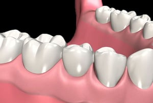 Protesi fissa – denti naturali: vista dell’arcata dentale con spazi vuoti per la riabilitazione protesica.