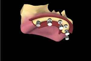 Vista frontale di protesi fissa supportata da impianti dentali