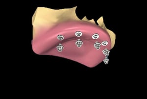 Inserimento viti implantari per protesi fissa mascellare