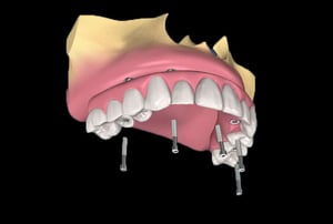 Schema mascellare con più impianti dentali per protesi fissa