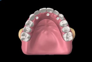 Schema chirurgico con pilastri implantari per protesi fissa