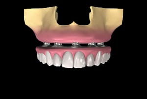 Protesi fissa avvitata a barra implantare nella mascella