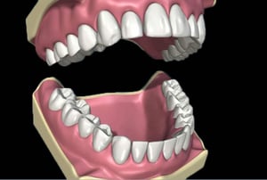 Protesi dentale parziale rimovibile con ganci metallici montata su modello digitale dell’arcata superiore e inferiore