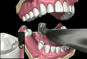 Protesi parziale rimovibile con struttura metallica e denti artificiali posteriori, vista frontale.