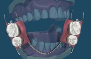 Preparazione di un dente pilastro con fresa per l’inserimento di un attacco di precisione.