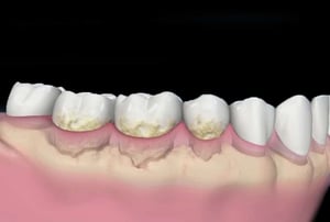 Illustrazione dei denti con abbondante placca e tartaro che causano infiammazione gengivale e riassorbimento osseo.
