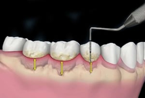 Rappresentazione della gengiva retratta che espone parte delle radici dentali dopo la rimozione della placca.