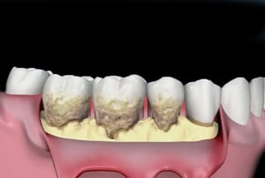 Simulazione grafica di tasche gengivali profonde e gengiva arrossata tipica della parodontite.