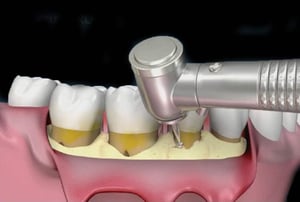 Utilizzo di strumenti rotanti per rimodellare l’osso alveolare durante la chirurgia resettiva.