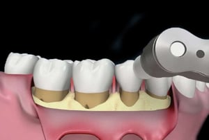Dettaglio dell’utilizzo di strumenti manuali per levigare le radici ed eliminare residui di tartaro.