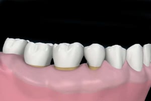 Sondaggio gengivale con sonda parodontale per misurare la profondità delle tasche dopo la chirurgia.