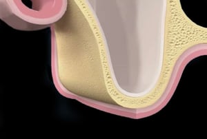 Osso mascellare con quantità insufficiente di osso disponibile per impianto dentale.